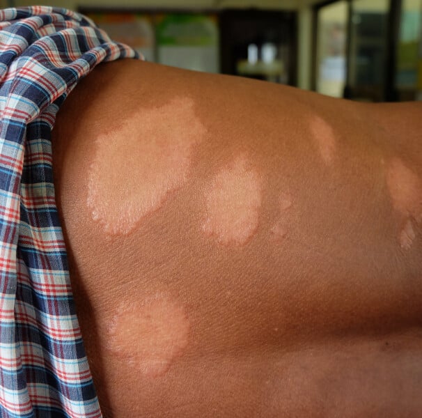 Prefeitura de Cuiabá intensifica ações de conscientização e combate à hanseníase